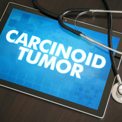 Causes, symptoms and risk factors of carcinoid tumor
