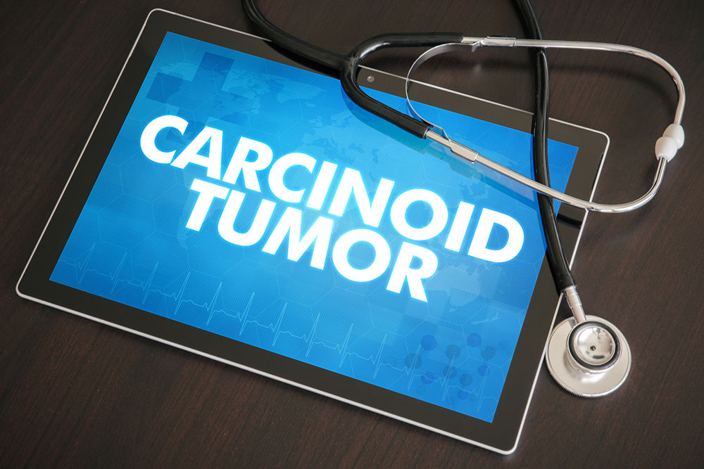 Causes, symptoms and risk factors of carcinoid tumor