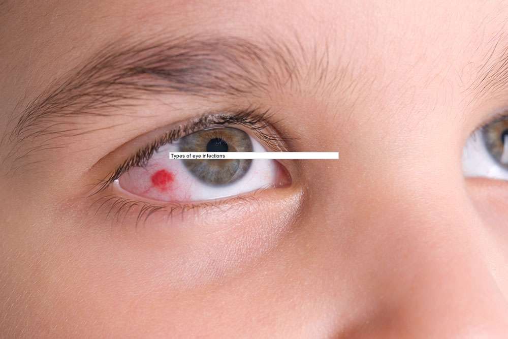 Types of eye infections